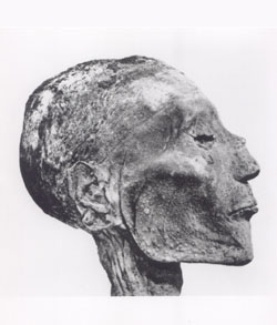 3000 year-old mummy of the Pharaoh Ramses V, shows traces of smallpox pustules on the head. (Image Credits: WHO)