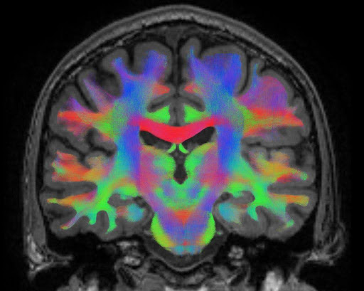 Neural networks shown in MRI scan. Courtesy: ESA