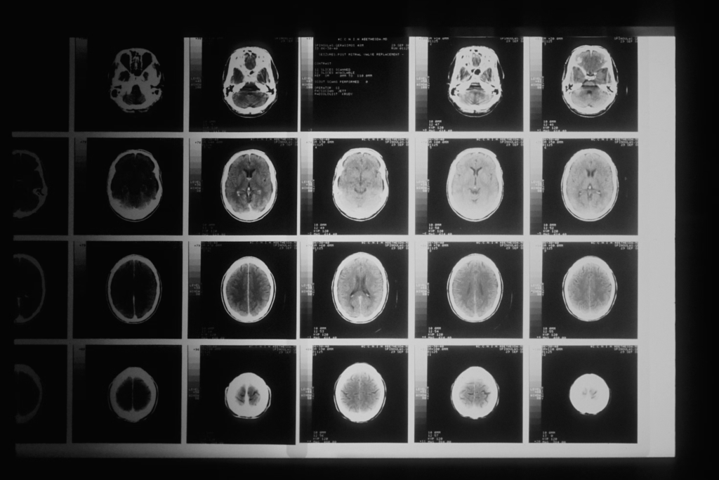 Radiations can cause long-lasting and irreversible changes in the overall chemistry of the brain.